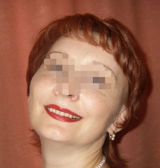 Результаты лечения: Мария Кочетова - фотография после лечения