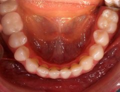 Результаты лечения: Пациентка И. - фотография после лечения