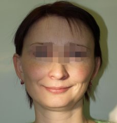 Результаты лечения: Мария Кочетова - фотография до лечения
