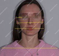 Результаты лечения: Пациентка - фотография после лечения