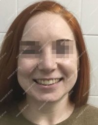 Результаты лечения: Пациентка Е. - фотография после лечения