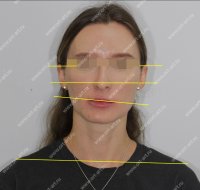 Результаты лечения: Пациентка - фотография до лечения